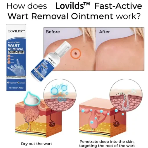 LOVILDS™ Fast-Active Wart Removal Ointment