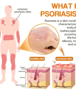 LOVILDS™PsoriaHeal psoriasis Spray pro