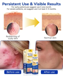 LOVILDS™PsoriaHeal psoriasis Spray pro