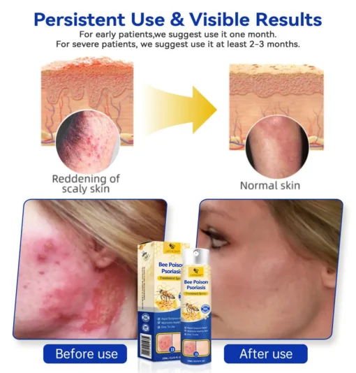 LOVILDS™PsoriaHeal psoriasis Spray pro