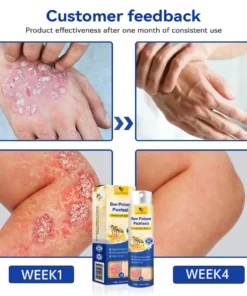 LOVILDS™PsoriaHeal psoriasis Spray pro