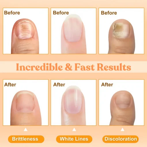 LOVILDS™ Bee Poison Nail Repair Treatment Spray