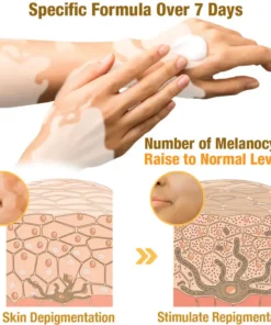 LOVILDS™ BeeVenom Vitiligo Treatment Cream