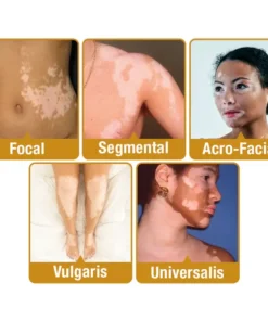 LOVILDS™ BeeVenom Vitiligo Treatment Cream