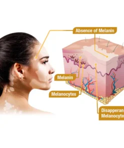 LOVILDS™ BeeVenom Vitiligo Treatment Cream