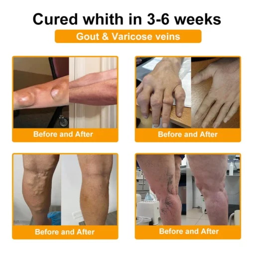 LOVILDS™ Botulinum Toxin & Bee Venom Pain-Relief Bone Healing Cream