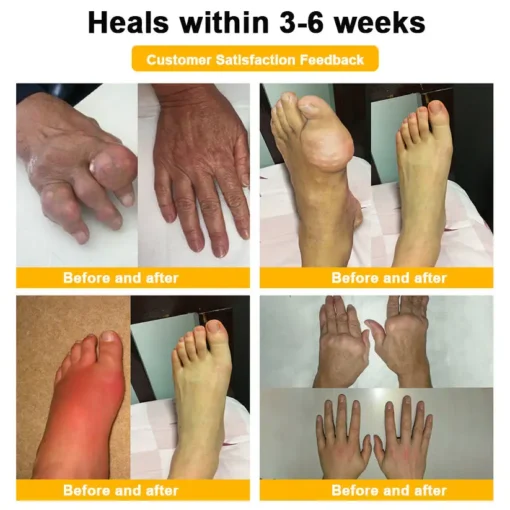 LOVILDS™ Botulinum Toxin & Bee Venom Pain-Relief Bone Healing Cream