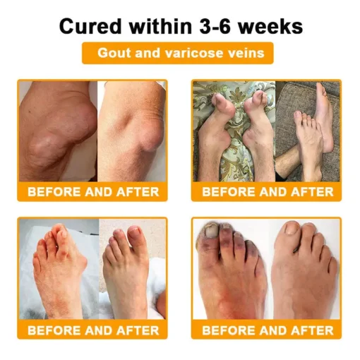 LOVILDS™ Botulinum Toxin & Bee Venom Pain-Relief Bone Healing Cream
