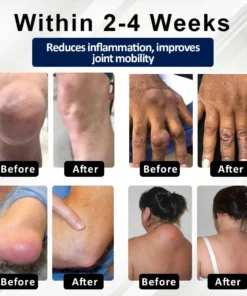 Lovilds™ BeeEase MicroSting Joint Patches