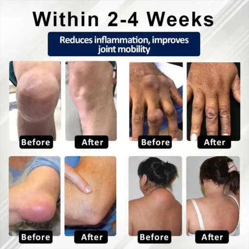 Lovilds™ BeeEase MicroSting Joint Patches
