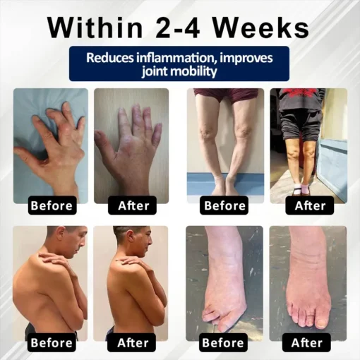Lovilds™ BeeEase MicroSting Joint Patches