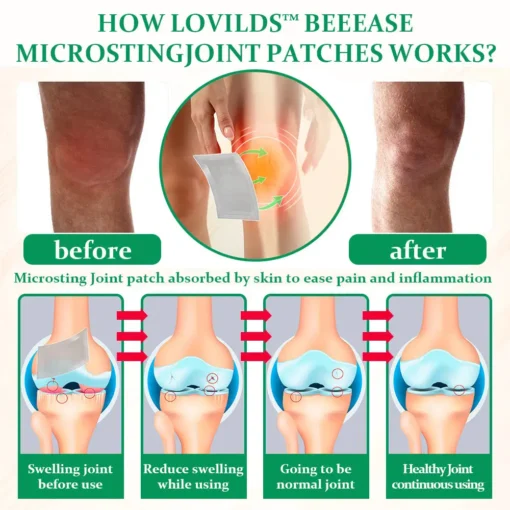 Lovilds™ BeeEase MicroSting Joint Patches