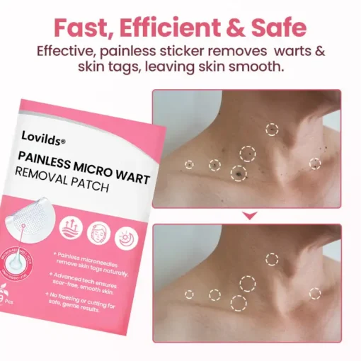 Lovilds® Painless Micro Wart Removal Patch