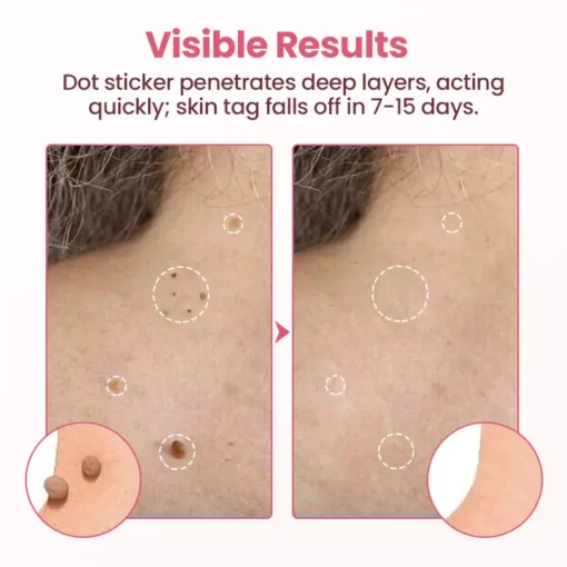 Lovilds® Painless Micro Wart Removal Patch