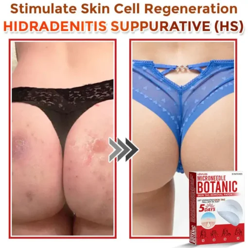 LOVILDS® MicroNeedle Botanic Skin Tag Removal Patch
