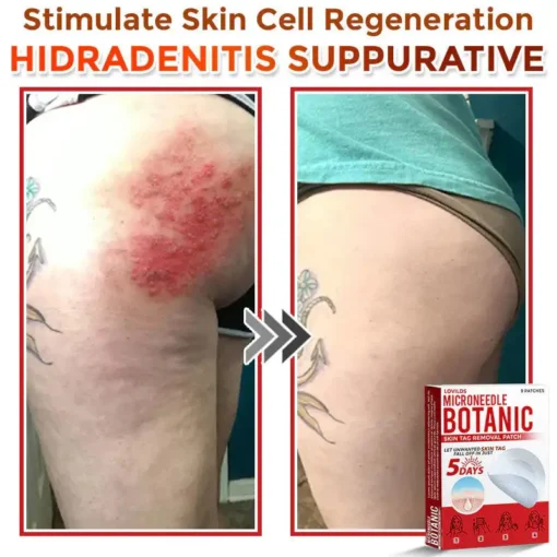 LOVILDS® MicroNeedle Botanic Skin Tag Removal Patch
