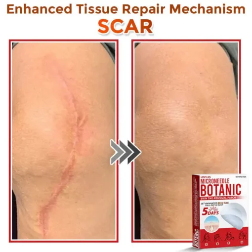 LOVILDS® MicroNeedle Botanic Skin Tag Removal Patch