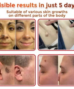 LOVILDS® MicroNeedle Botanic Skin Tag Removal Patch