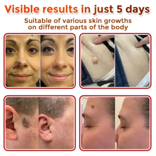 LOVILDS® MicroNeedle Botanic Skin Tag Removal Patch