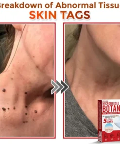 LOVILDS® MicroNeedle Botanic Skin Tag Removal Patch