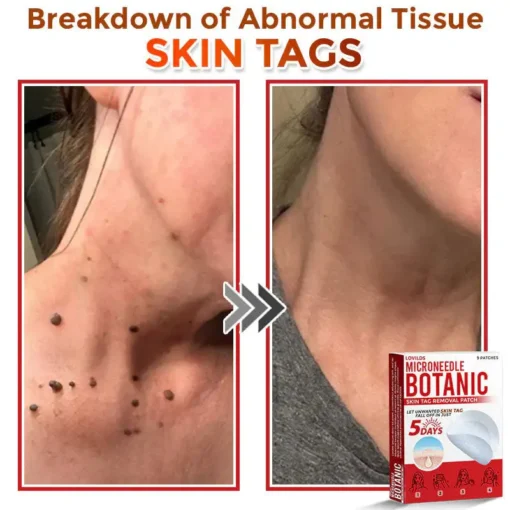 LOVILDS® MicroNeedle Botanic Skin Tag Removal Patch