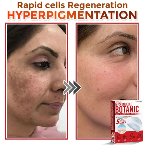 LOVILDS® MicroNeedle Botanic Skin Tag Removal Patch
