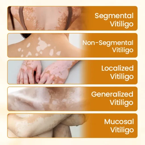Lovilds® VitiCalm Bee Toxin Cream