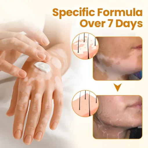 Lovilds® VitiCalm Bee Toxin Cream