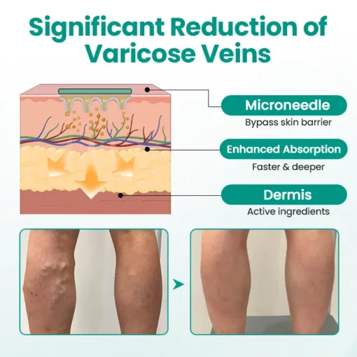 LOVILDS® LegRenew Varicose Veins Patch