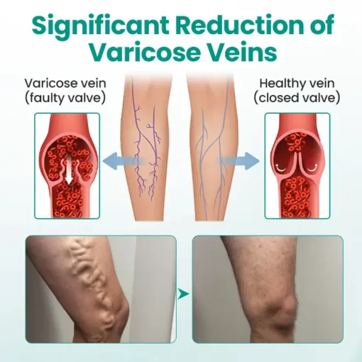 LOVILDS® LegRenew Varicose Veins Patch