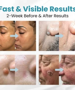 LOVILDS™ Non-Invasive Mole and Wart Removal Patch