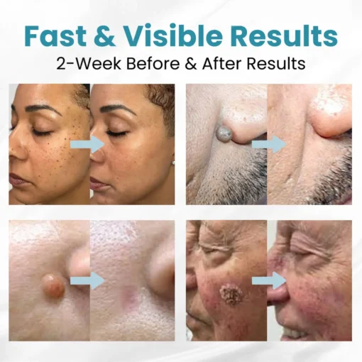 LOVILDS™ Non-Invasive Mole and Wart Removal Patch