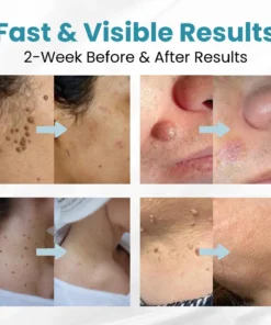 LOVILDS™ Non-Invasive Mole and Wart Removal Patch