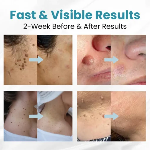 LOVILDS™ Non-Invasive Mole and Wart Removal Patch
