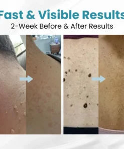 LOVILDS™ Non-Invasive Mole and Wart Removal Patch
