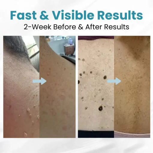 LOVILDS™ Non-Invasive Mole and Wart Removal Patch