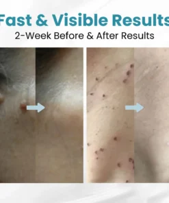 LOVILDS™ Non-Invasive Mole and Wart Removal Patch