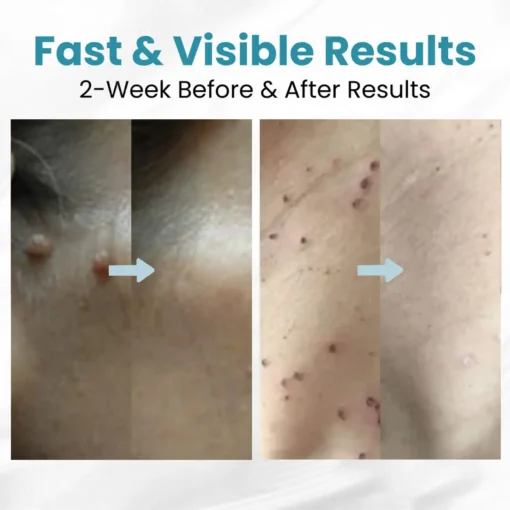 LOVILDS™ Non-Invasive Mole and Wart Removal Patch