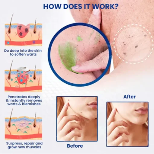 LOVILDS™ Ultra NatureErase Instant Mole & Spot Removal Gel