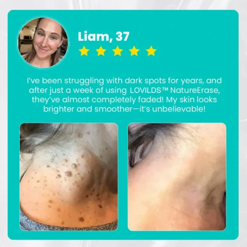 LOVILDS™ Ultra NatureErase Instant Mole & Spot Removal Gel