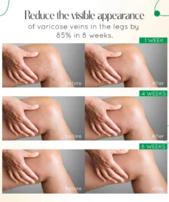 LOVILDS™ Vein Therapy Cream