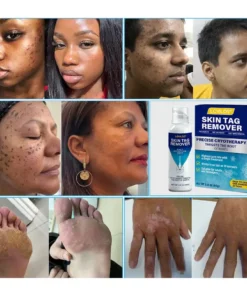 Lovilds® TagRecede Cryo Treatment Spray