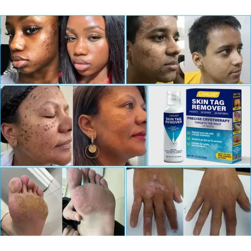 Lovilds® TagRecede Cryo Treatment Spray