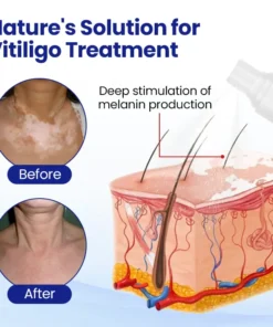 Lovilds® Vitiligo Treatment Spray
