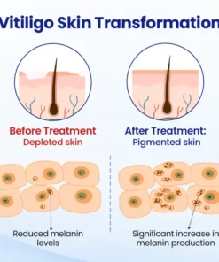 Lovilds® Vitiligo Treatment Spray
