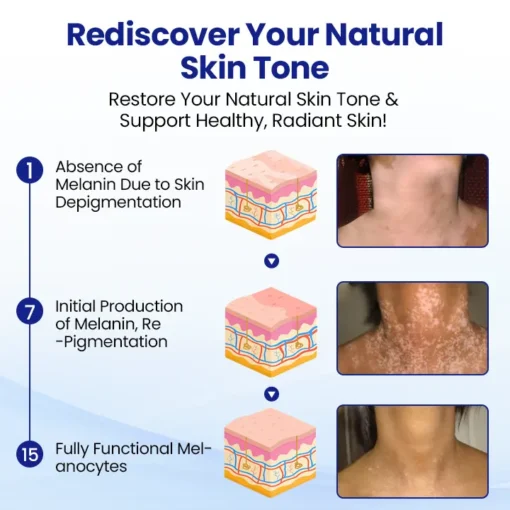 Lovilds® Vitiligo Treatment Spray