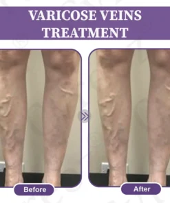 LOVILDS™ Care Phyto Cream-HelpsTreat Varicose Veins,Swelling,cramps and Leg Pain