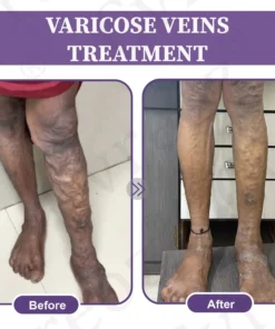 LOVILDS™ Care Phyto Cream-HelpsTreat Varicose Veins,Swelling,cramps and Leg Pain