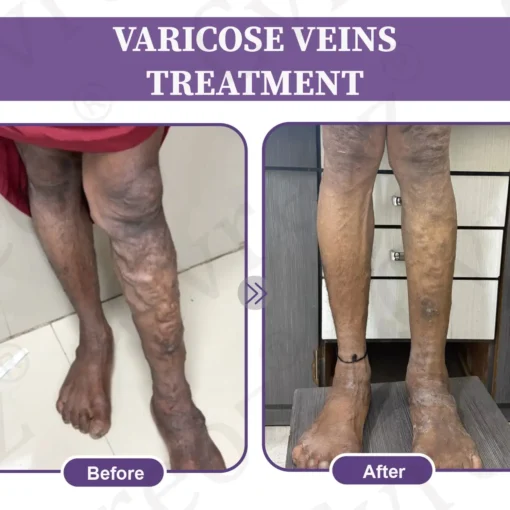 LOVILDS™ Care Phyto Cream-HelpsTreat Varicose Veins,Swelling,cramps and Leg Pain