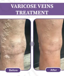 LOVILDS™ Care Phyto Cream-HelpsTreat Varicose Veins,Swelling,cramps and Leg Pain